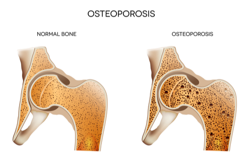 bone density example